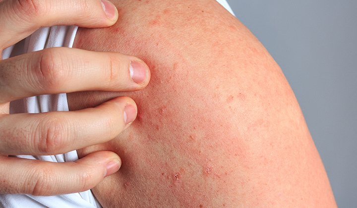 Hautausschlag am Arm